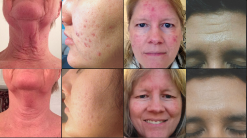 Asea Before and After 3